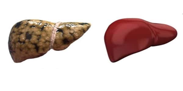 طرق علاج دهون الكبد